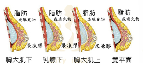 1. 果凍膠假體 + 自體脂肪移植  |服務項目|體形雕塑|複合式豐胸隆乳