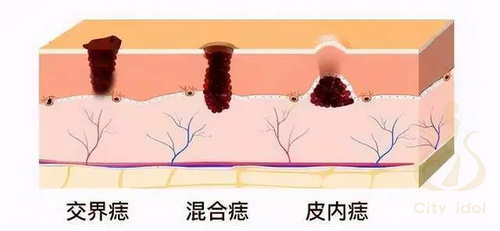 1. 電波刀除痣 < 除黑痣 > 