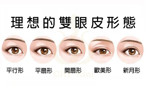 1.單純割雙眼皮 