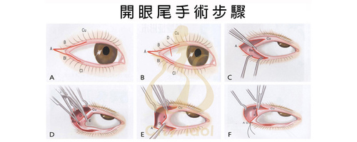 2. 開眼尾(外眥成形術) 