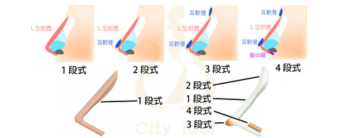 3(A).朝天鼻 < 延長短鼻 > { 併增高山根, 拉長鼻尖及修飾鼻孔 } [Ｌ型2段 ] 