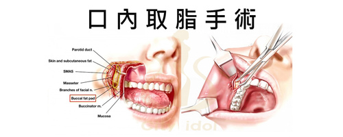 1. 單純口內取脂手術產品圖