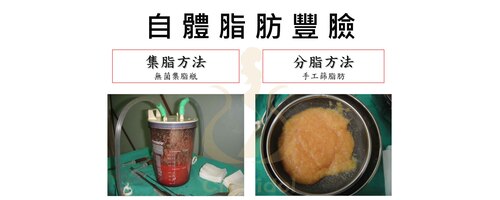 2. 自體脂肪豐臉 < 豐全臉 > [ 男 ] 