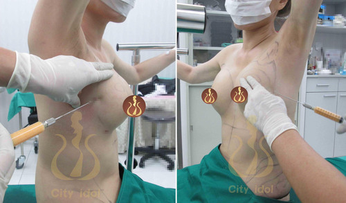 5. 自體脂肪豐胸 < 畸型乳房 > 