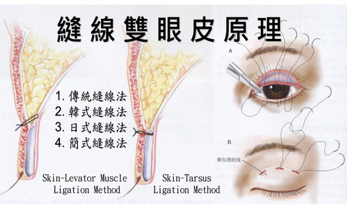 A03.釘書機 - 單眼皮 < 下垂 >  |服務項目|顏面整形|眼部手術|縫線雙眼皮