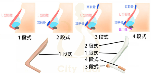 1(C).馬鞍鼻 < 撐高鼻頭 > { 併加強鼻柱及加挺鼻尖 } [Ｌ型2段 ]  |服務項目|顏面整形|鼻部手術|內開結構式隆鼻