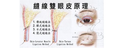 A07. 釘書機 - 大小眼 < 一單一雙 >A  |案例分享|顏面整形|眼部手術|釘書機雙眼皮