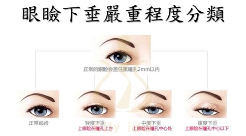 2. 老化性提瞼肌乏力矯正 