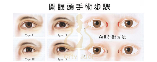 1. 開眼頭(內眥成形術)A 