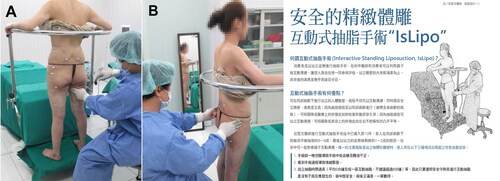 2. 大腿互動式抽脂 < 大腿環抽 >  |案例分享|體形雕塑|互動式站立抽脂