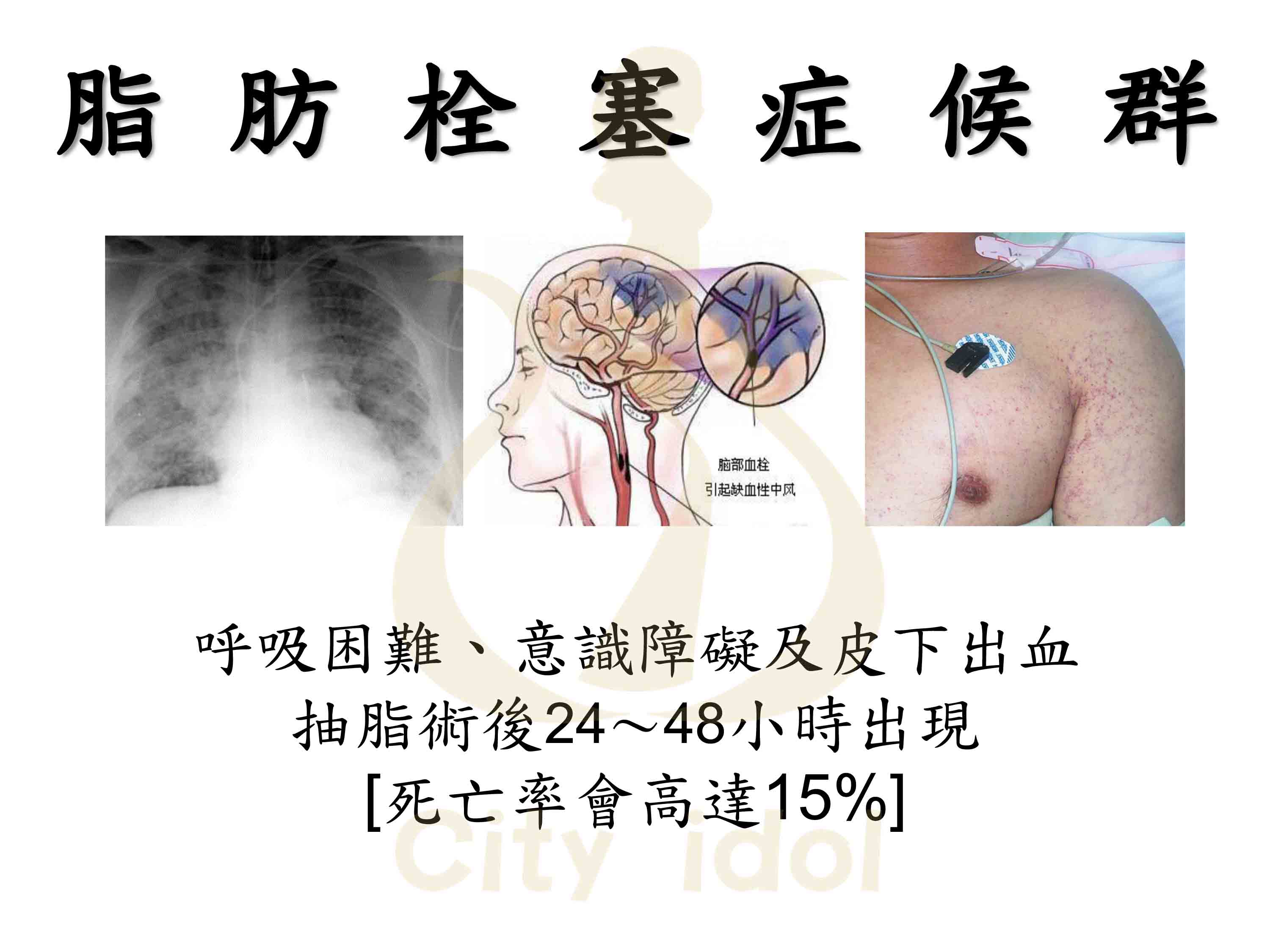 脂肪栓塞症候群